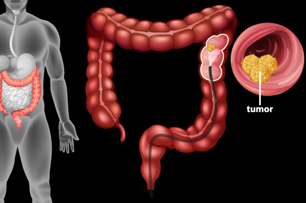 Ova jednostavna navika može smanjiti rizik od raka debelog crijeva za čak 40 %!