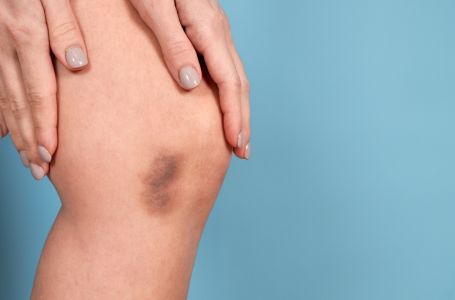 Ovi simptomi ukazuju da vam nedostaje vitamin C: Ne ignorišite ih