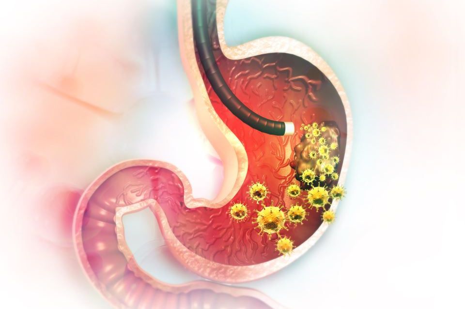 5 ranih simptoma raka želuca: Tumor može da raste godinama, a svi pacijenti prvo osjete ovo