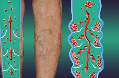 Najraniji signali da se u tijelu formirao tromb: Ove simptome nije pametno ignorisati