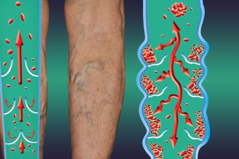 Najraniji signali da se u tijelu formirao tromb: Ove simptome nije pametno ignorisati