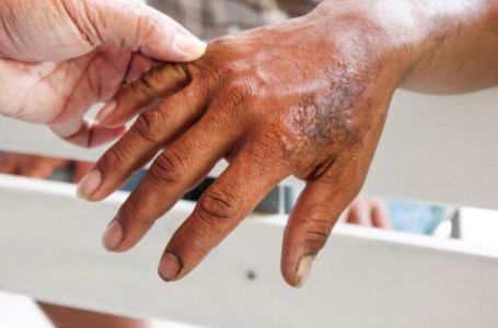 U Hrvatskoj potvrđen slučaj gube!