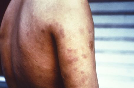 Objavljeno u kakvom je stanju oboljeli od gube u Hrvatskoj: "Rizik širenja je vrlo malen"