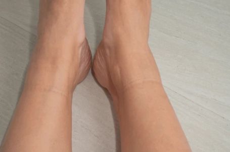 Ako vam na nogama ostaju usjekli tragovi od čarapa, nije bezazleno! Evo šta tijelo poručuje