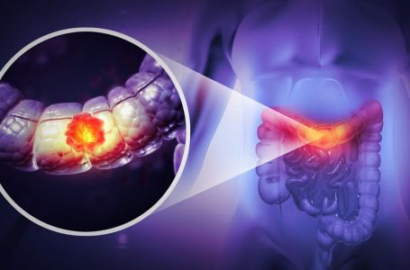 Čak 91 % veći rizik od raka debelog crijeva: Ova navika može vas skupo stajati!