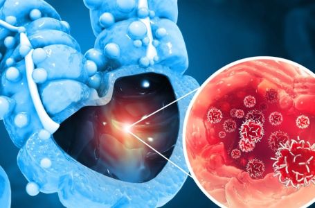 Tihi signali opake bolesti: Ovo su 4 znaka raka debelog crijeva koje tijelo šalje mjesecima prije