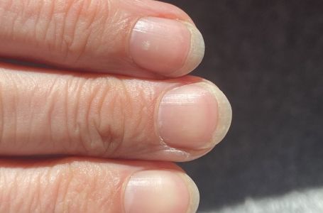 Simptom na noktima koji može biti rani znak zatajenja srca ili bolesti jetre