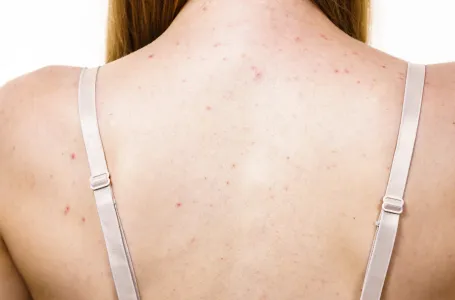 Kako se nositi s prištićima na leđima? 6 grešaka koje pogoršavaju stanje kože i pojačavaju problem