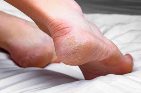 Domaći melem za grube i ispucale pete bake su znale napamet: Koriste se 2 prirodna sastojka