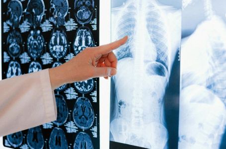 Znanstvenici otkrili što višestruko povećava rizik od raka pluća, posebno kod nepušača
